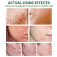 Acne Treatment Serum Facial Repair Oil